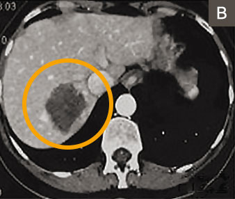 hirslanden-lebermetastasen-2