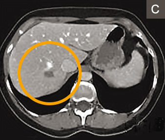 hirslanden-lebermetastasen-3