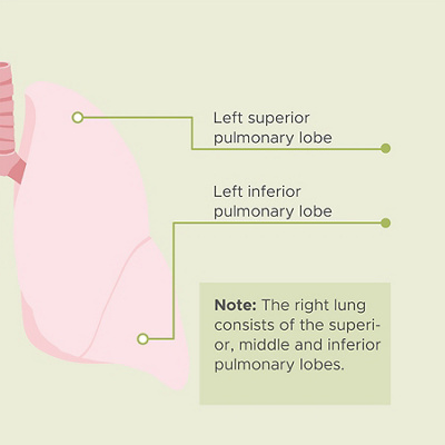Infographic cours of a lung inflamation 2