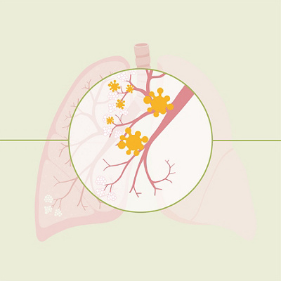 Infographic cours of a lung inflamation 8