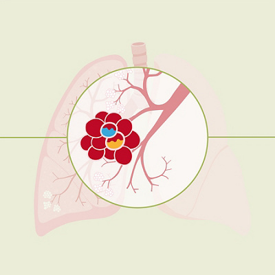 Infographic cours of a lung inflamation 10