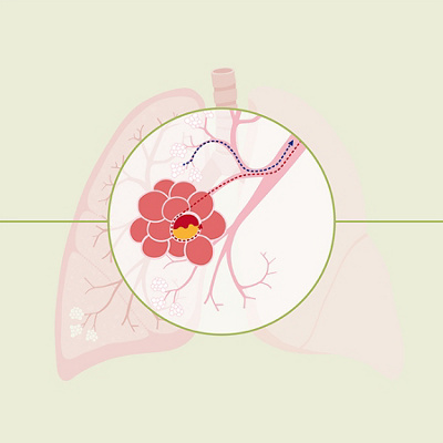 Infographic cours of a lung inflamation 12