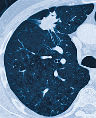 hirslanden-lungenkrebs-1