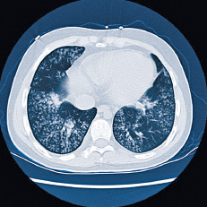 hirslanden-lungenkrebs-2