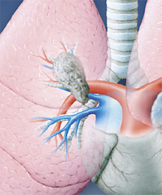 hirslanden-lungenkrebs-operabel-2