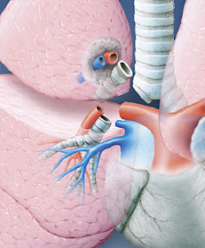 hirslanden-lungenkrebs-operabel-3