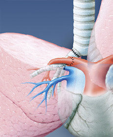 hirslanden-lungenkrebs-operabel-4