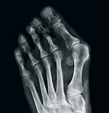 hirslanden-metatarsalgie-2