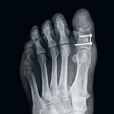 hirslanden-metatarsalgie-3