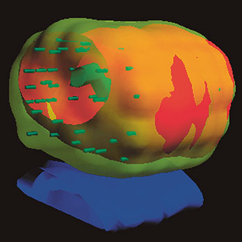 hirslanden-mini-implantate-bei-prostatakrebs-2