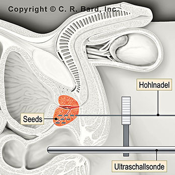 hirslanden-mini-implantate-bei-prostatakrebs-3