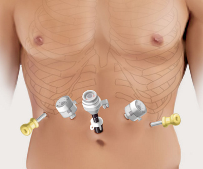 hirslanden-minimalinvasive-chirurgie-des-speiseroehrenkrebses-1