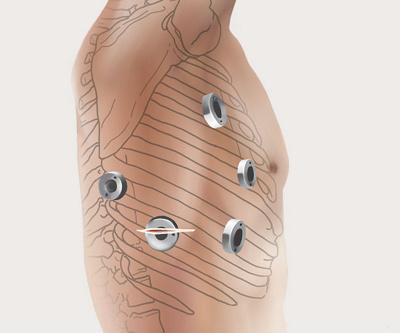 hirslanden-minimalinvasive-chirurgie-des-speiseroehrenkrebses-2