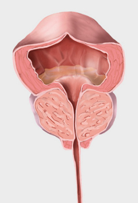 Prostata Embolisation - Checkup das Gesundheitsmagazin