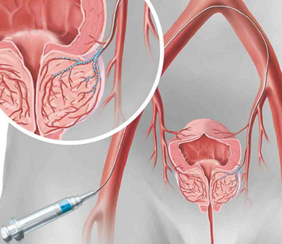 Minimalinvasiver Gefässverschluss