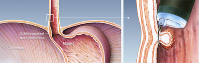 hirslanden-mit-schlinge-und-ballon-gegen-speiseroehrenkrebs-5