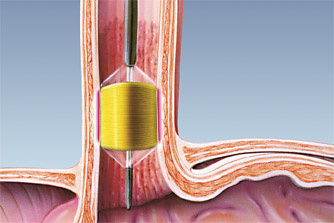 hirslanden-mit-schlinge-und-ballon-gegen-speiseroehrenkrebs-6