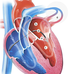 hirslanden-mitralinsuffizienz-1