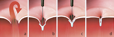 hirslanden-mitralinsuffizienz-4