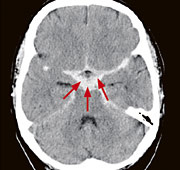 hirslanden-moderne-bildgebung-bei-kopfschmerzen-2