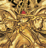 hirslanden-moderne-bildgebung-bei-kopfschmerzen-3