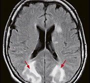 hirslanden-moderne-bildgebung-bei-kopfschmerzen-4