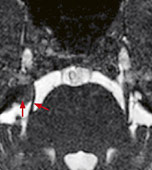 hirslanden-moderne-bildgebung-bei-kopfschmerzen-5