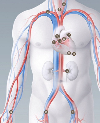 hirslanden-moderne-interventionelle-kardiologie-1