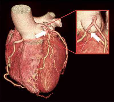 hirslanden-moderne-methodenzur-abklaerung-von-brustschmerzen-1