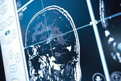 hirslanden-multiple-sklerose-2