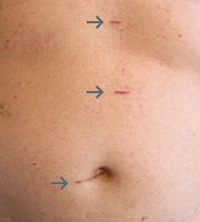 hirslanden-narbenfrei-operieren-3