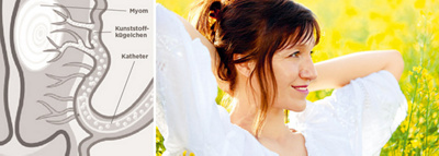 hirslanden-neue-behandlungsmoeglichkeiten-fuer-gutartige-gebaermutterknoten-1