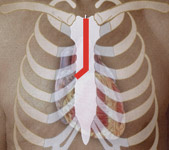 hirslanden-neue-chirurgische-verfahren-zum-ersatz-der-aortenklappe-1