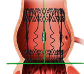 hirslanden-neue-chirurgische-verfahren-zum-ersatz-der-aortenklappe-3