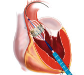 hirslanden-neue-chirurgische-verfahren-zum-ersatz-der-aortenklappe-4