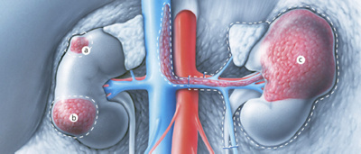 hirslanden-nierenkrebs-1