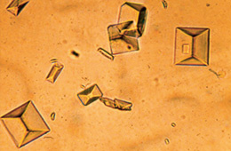 hirslanden-nierensteine-eine-gemeinsame-herausforderung-fuer-urologie-und-nephrologie-3