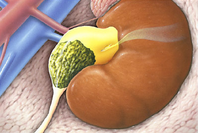 hirslanden-nierensteine-werden-immer-haeufiger-1