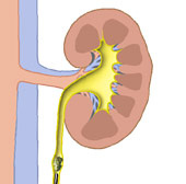 hirslanden-nierensteine-werden-immer-haeufiger-2