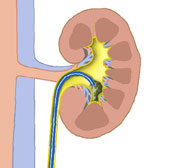 hirslanden-nierensteine-werden-immer-haeufiger-3