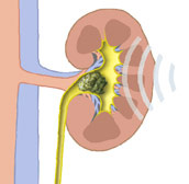 hirslanden-nierensteine-werden-immer-haeufiger-4