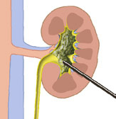 hirslanden-nierensteine-werden-immer-haeufiger-5