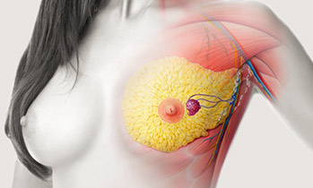 hirslanden-operative-therapiemoeglichkeiten-bei-brustkrebs-2