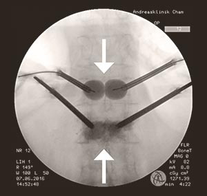 hirslanden-osteoporosebedingte-frakturen-der-wirbelsaeule-1