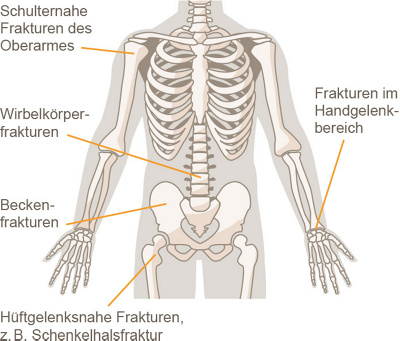 hirslanden-osteoporotische-frakturen-1