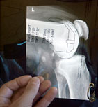 hirslanden-planung-und-implantation-eines-kuenstlichen-kniegelenkes-1