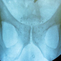 hirslanden-prostatakrebs-2