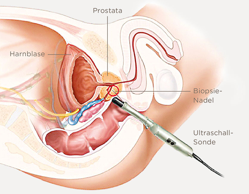 Wie stellt der Urologe Prostatakrebs fest?