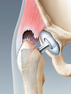 hirslanden-revision-von-kuenstlichen-hueftgelenken-1