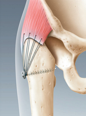 hirslanden-revision-von-kuenstlichen-hueftgelenken-2